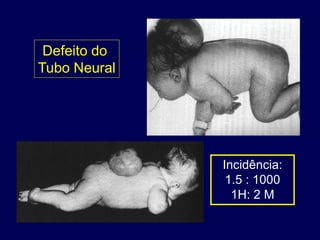 Defeito do
Tubo Neural




              Incidência:
               1.5 : 1000
                1H: 2 M
 