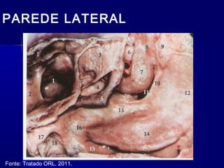 PAREDE LATERAL
Fonte: Tratado ORL. 2011.
 