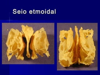 Seio etmoidalSeio etmoidal
 