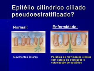 Epitélio cilíndrico ciliadoEpitélio cilíndrico ciliado
pseudoestratificado?pseudoestratificado?
Normal: Enfermidade:
Paralisia de movimentos ciliares
com estase de secreções e
colonização de bactérias
Movimentos ciliares
 
