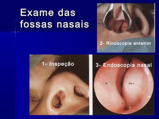 Exame dasExame das
fossas nasaisfossas nasais
1- Inspeção 3- Endoscopia nasal
2- Rinoscopia anterior
 
