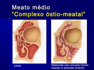 Meato médioMeato médio
“Complexo óstio-meatal”“Complexo óstio-meatal”
Livre Obstruído com sinusite fronto-
maxilar e etmoidal anterior
 