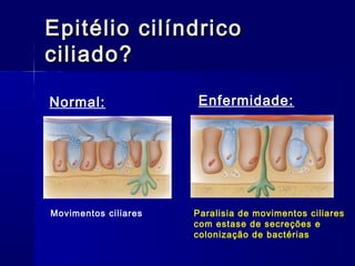Epitélio cilíndricoEpitélio cilíndrico
ciliado?ciliado?
Normal: Enfermidade:
Paralisia de movimentos ciliares
com estase de secreções e
colonização de bactérias
Movimentos ciliares
 
