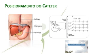 RALLY ADJUSTED VENTILATORY ASSISTPOSICIONAMENTO DO CATETER
 