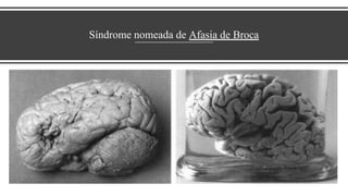Síndrome nomeada de Afasia de Broca
 