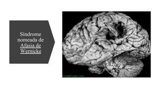 Síndrome
nomeada de
Afasia de
Wernicke
 