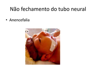 Não fechamento do tubo neural
• Anencefalia
 