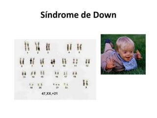 Síndrome de Down
 