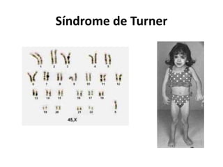Síndrome de Turner
 