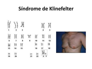 Síndrome de Klinefelter
 