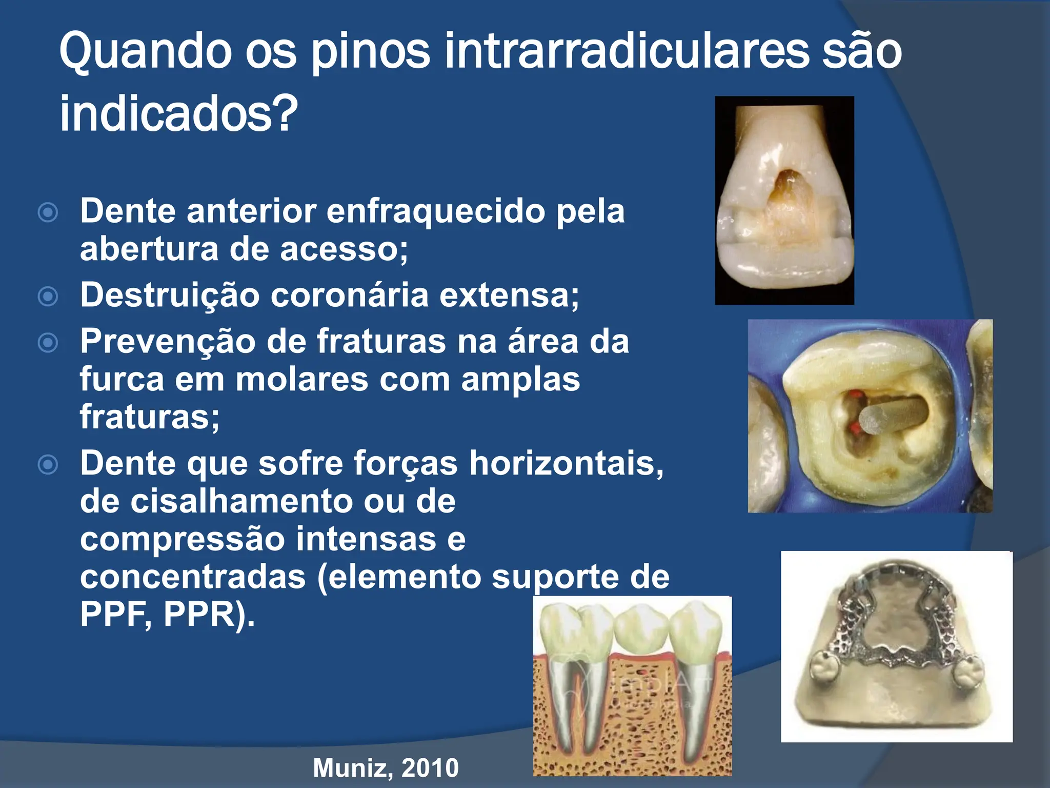 Aula Nucleo metalico fundido para dentes tratados endodonticamente | PDF