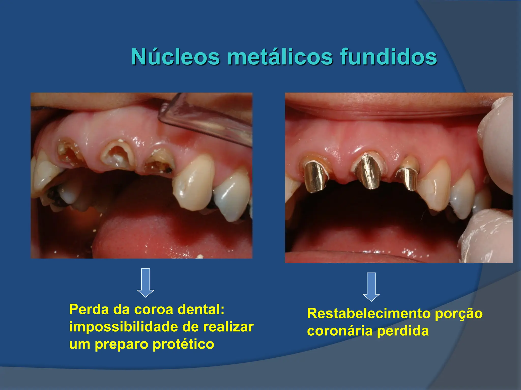 Aula Nucleo metalico fundido para dentes tratados endodonticamente | PDF
