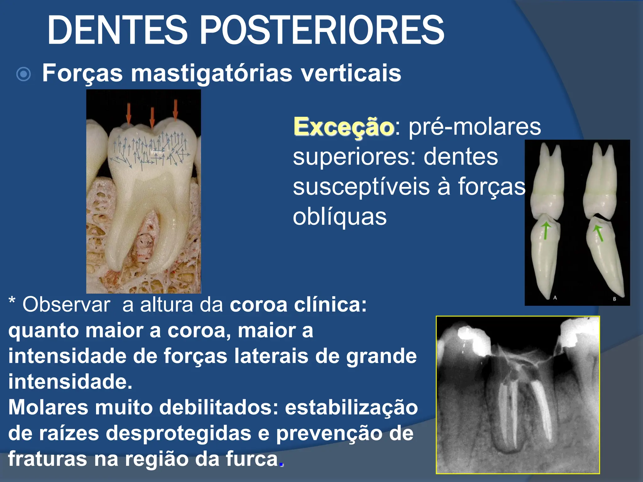 Aula Nucleo metalico fundido para dentes tratados endodonticamente | PDF