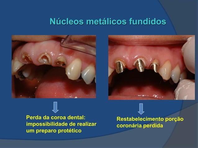 Aula Nucleo metalico fundido para dentes tratados endodonticamente | PDF