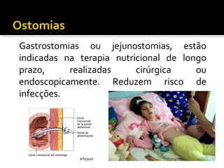 Gastrostomias ou jejunostomias, estão
indicadas na terapia nutricional de longo
prazo,     realizadas     cirúrgica    ou
endoscopicamente. Reduzem risco de
infecções.
 
