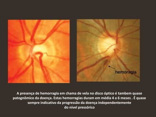 A presença de hemorragia em chama de vela no disco óptico é tambem quase
patognômico da doença. Estas hemorragias duram em média 4 a 6 meses . É quase
sempre indicativo da progressão da doença independentemente
do nível pressórico
 