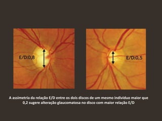 A assimetria da relação E/D entre os dois discos de um mesmo individuo maior que
0,2 sugere alteração glaucomatosa no disco com maior relação E/D
 