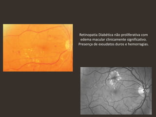 Retinopatia Diabética não proliferativa com
edema macular clinicamente significativo.
Presença de exsudatos duros e hemorragias.
 