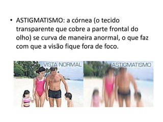 • ASTIGMATISMO: a córnea (o tecido
transparente que cobre a parte frontal do
olho) se curva de maneira anormal, o que faz
com que a visão fique fora de foco.

 