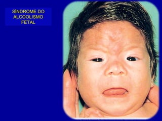 SÍNDROME DO
ALCOOLISMO
    FETAL
 