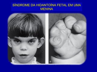 SÍNDROME DA HIDANTOÍNA FETAL EM UMA
              MENINA
 