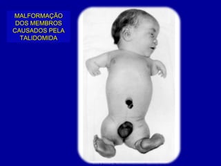 MALFORMAÇÃO
 DOS MEMBROS
CAUSADOS PELA
  TALIDOMIDA
 