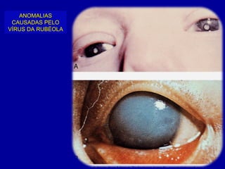 ANOMALIAS
 CAUSADAS PELO
VÍRUS DA RUBÉOLA
 