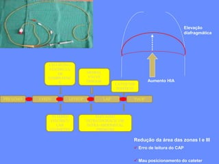 Aumento HIA
Elevação
diafragmática
Redução da área das zonas I e III
 Erro de leitura do CAP
 Mau posicionamento do cateter
PRE LOAD LVEDV LEVEDP LAP PAOP
CHANGING
VENTRICUL
AR
COMPLIANC
E
ALTERED
VENTRICU
LAR
GEOMETRY
MITRAL
VALVE
DISEASE
ELEVATED
INTRATHORACIC OR
INTRA-ABDOMINAL
PRESSURE
CATHETER
POSITION
 