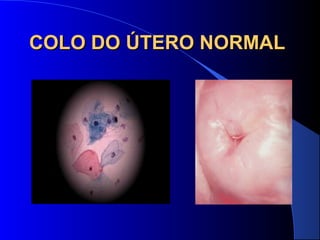 COLO DO ÚTERO NORMALCOLO DO ÚTERO NORMAL
 