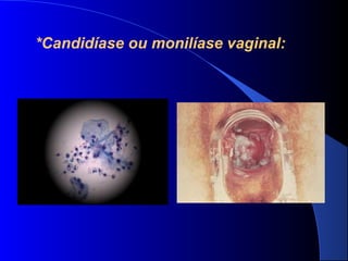  
*Candidíase ou monilíase vaginal: 
 