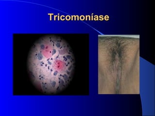 TricomoníaseTricomoníase  
 