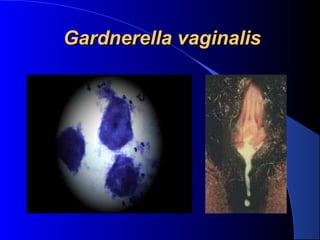 Gardnerella vaginalisGardnerella vaginalis  
 