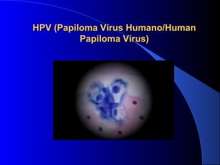 HPV (Papiloma VHPV (Papiloma Víírus Humano/Human rus Humano/Human 
Papiloma Virus)Papiloma Virus)
 