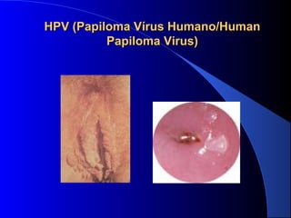 HPV (Papiloma VHPV (Papiloma Víírus Humano/Human rus Humano/Human 
Papiloma Virus)Papiloma Virus)
 
