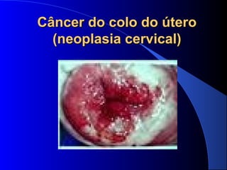Câncer do colo do útero Câncer do colo do útero 
(neoplasia cervical)(neoplasia cervical)
 