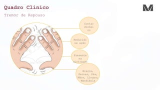 Quadro Clínico
Contar
dinhei
ro
Reduzido
na ação
Presente
na
distração
Braços,
Pernas, Pés,
Mãos, Língua,
Mandíbula
Tremor de Repouso
 