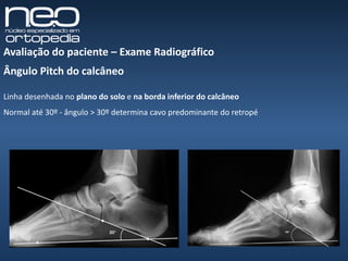 Aula pé cavo | PPT