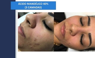 ÁCIDO MANDÉLICO 40%
(3 CAMADAS)
 