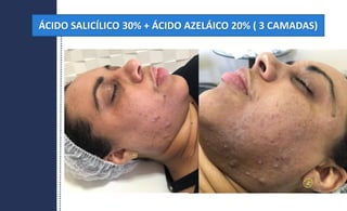 ÁCIDO SALICÍLICO 30% + ÁCIDO AZELÁICO 20% ( 3 CAMADAS)
 