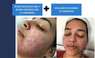 ÁCIDO SALICÍLICO 30% +
ÁCIDO AZELÁICO 20%
(2 CAMADAS)
SOLUÇÃO DE JESSNER
(2 CAMADAS)
 