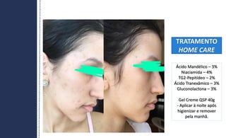 TRATAMENTO
HOME CARE
Ácido Mandélico – 3%
Niaciamida – 4%
TG2-Pepitídeo – 2%
Ácido Tranexâmico – 3%
Gluconolactona – 3%
Gel Creme QSP 40g
- Aplicar à noite após
higienizar e remover
pela manhã.
 