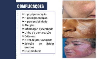 COMPLICAÇÕES
Hipopigmentação
Hiperpigmentação
Hipersensibilidade
Alergias
Inflamação exacerbada
Linha de demarcação
Eritemas
Nível de profundidade
Seleção de ácidos
errados
Queimaduras
 