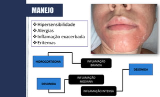 MANEJO
Hipersensibilidade
Alergias
Inflamação exacerbada
Eritemas
HIDROCORTISONA
DESONIDA
INFLAMAÇÃO
MEDIANA
INFLAMAÇÃO
BRANDA
INFLAMAÇÃO INTENSA
DESONIDA
 