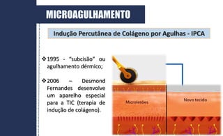 Indução Percutânea de Colágeno por Agulhas - IPCA
1995 - “subcisão” ou
agulhamento dérmico;
2006 – Desmond
Fernandes desenvolve
um aparelho especial
para a TIC (terapia de
indução de colágeno).
MICROAGULHAMENTO
 