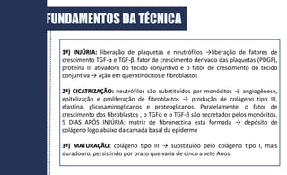 1ª) INJÚRIA: liberação de plaquetas e neutrófilos →liberação de fatores de
crescimento TGF-α e TGF-β, fator de crescimento derivado das plaquetas (PDGF),
proteína III ativadora do tecido conjuntivo e o fator de crescimento do tecido
conjuntiva → ação em queratinócitos e fibroblastos
2ª) CICATRIZAÇÃO: neutrófilos são substituídos por monócitos → angiogênese,
epitelização e proliferação de fibroblastos → produção de colágeno tipo III,
elastina, glicosaminoglicanos e proteoglicanos. Paralelamente, o fator de
crescimento dos fibroblastos , o TGFα e o TGF-β são secretados pelos monócitos.
5 DIAS APÓS INJÚRIA: matriz de fibronectina está formada → depósito de
colágeno logo abaixo da camada basal da epiderme
3ª) MATURAÇÃO: colágeno tipo III → substituído pelo colágeno tipo I, mais
duradouro, persistindo por prazo que varia de cinco a sete Anos.
FUNDAMENTOS DA TÉCNICA
 