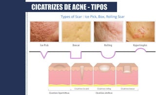 CICATRIZES DE ACNE - TIPOS
 