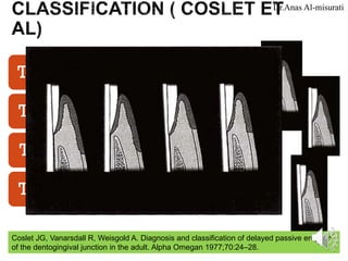 Aula de Cirurgia periodontal PERIO SUGERY .pdf