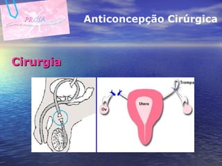 Cirurgia Anticoncepção Cirúrgica 