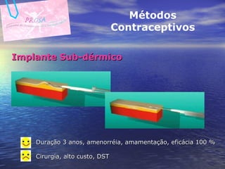 Implante Sub-dérmico Métodos Contraceptivos Duração 3 anos, amenorréia, amamentação, eficácia 100 % Cirurgia, alto custo, DST   