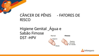 CÂNCER DE PÊNIS - FATORES DE
RISCO
Higiene Genital _Água e
Sabão Fimose
DST -HPV
 